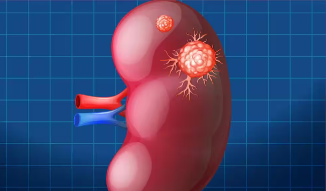Kidney Cancer : నగరవాసుల్లో పెరుగుతోన్న కిడ్నీ క్యాన్సర్ కేసులు.. కారణాలు, తీసుకోవాల్సిన జాగ్రత్తలు సూచిస్తోన్న ఆంకాలజిస్ట్