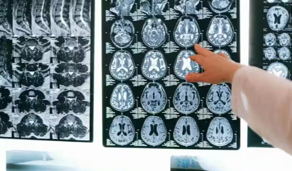 Viral News: పాతికేళ్ల యువకుడికి 70 ఏళ్ల మెదడు! మెడికల్ హిస్టరీలోనే వింతైన కేసు!