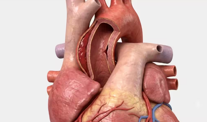 Aortic Dissection : అయోర్టిక్ డిసెక్షన్ లక్షణాలను అస్సలు నిర్లక్ష్యం చేయకండి.. ఇది గుండెపోటు కంటే ప్రమాదమా?